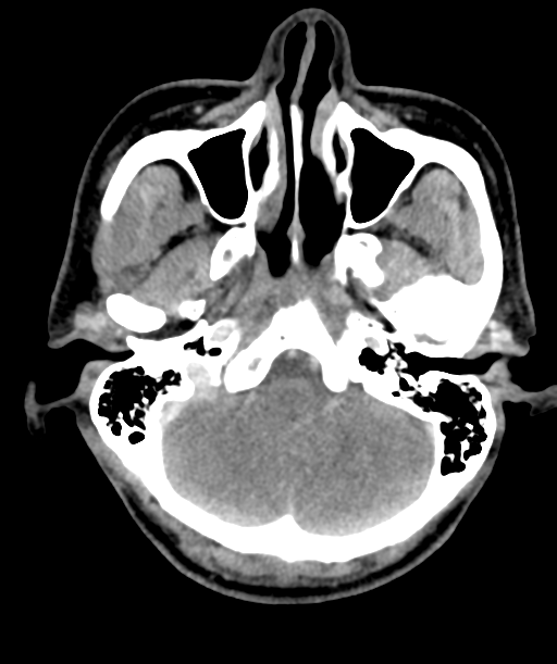 Cervical abscess (Radiopaedia 43725-47184 A 6).png