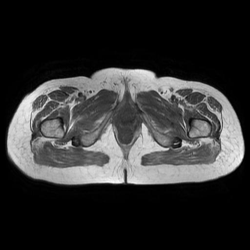 File:Cervical carcinoma (Radiopaedia 67644-77047 Axial T1 20).jpg