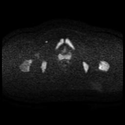 Cervical carcinoma (Radiopaedia 88010-104555 Axial DWI 63).jpg