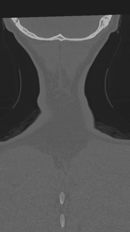 Cervical intercalary bone (Radiopaedia 35211-36748 Coronal bone window 79).png