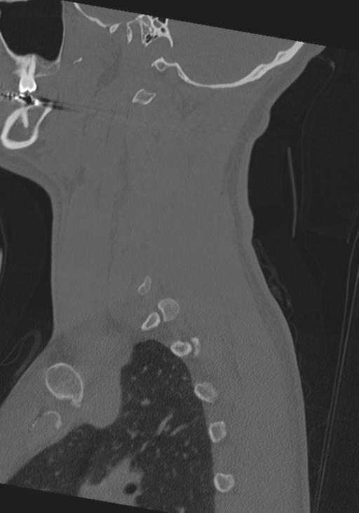 Cervical intercalary bone (Radiopaedia 35211-36748 Sagittal bone window 63).png