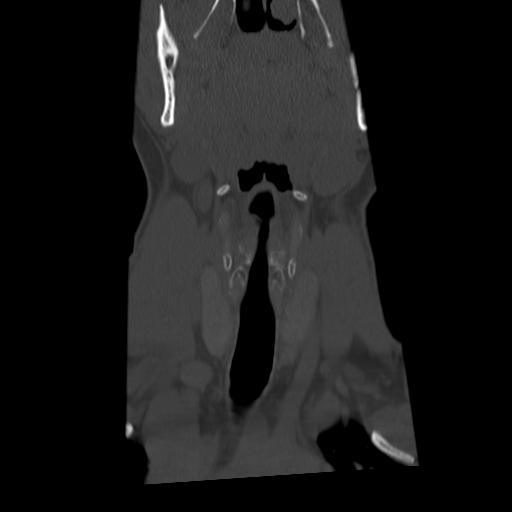 Cervical schwannoma (Radiopaedia 57979-64974 Coronal bone window 13).png