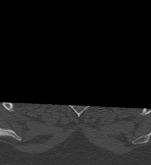 Cervical spine ACDF loosening (Radiopaedia 48998-54070 Axial bone window 65).png