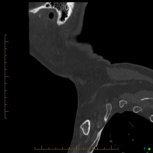 Cervical spine fracture - ankylosing spondylitis (Radiopaedia 76835-88706 Sagittal bone window 1).jpg