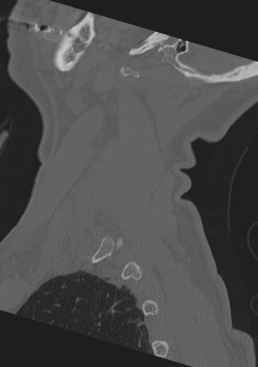 Cervical spine fractures with vertebral artery dissection (Radiopaedia 53296-59268 Sagittal bone window 63).png