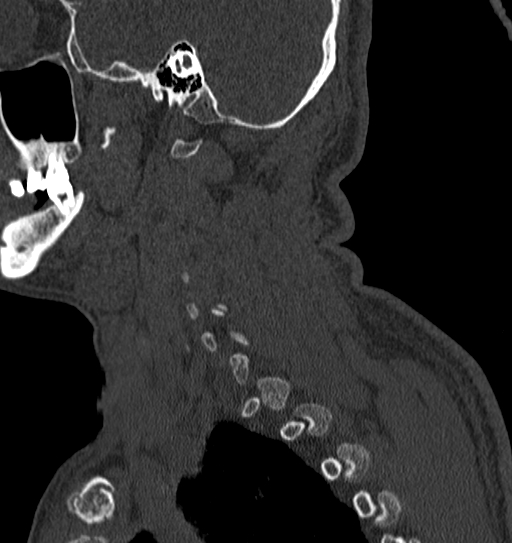 Cervical spine trauma with tear drop fracture and perched facet joint (Radiopaedia 53989-60127 Sagittal bone window 7).jpg