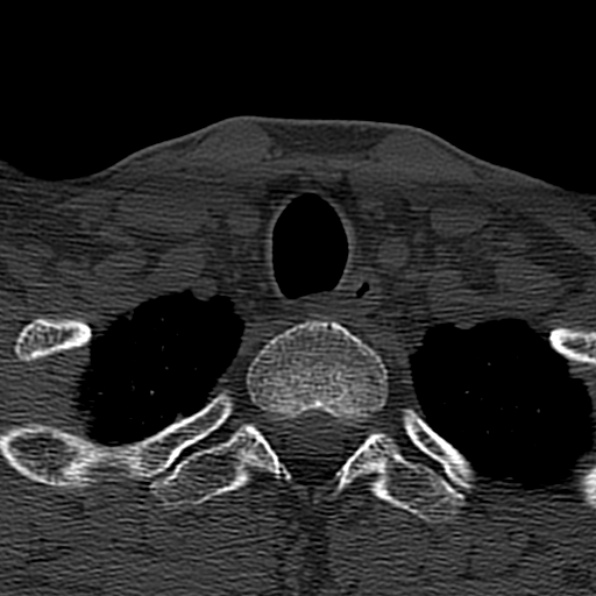 Cervical spondylodiscitis (Radiopaedia 28057-29489 Axial bone window 73).jpg