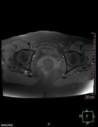 File:Cesarian scar endometriosis (Radiopaedia 68495-78066 Axial T1 fat sat 19).jpg
