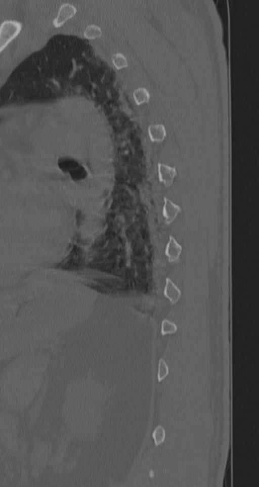 Chance fracture (Radiopaedia 33854-35020 Sagittal bone window 19).png
