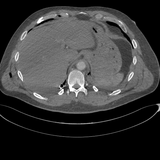 File:Chest multitrauma - aortic injury (Radiopaedia 34708-36147 A 261).png