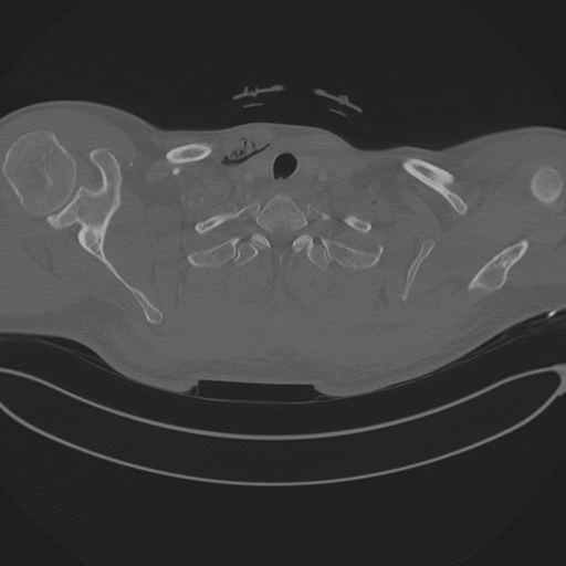 Chest multitrauma - aortic injury (Radiopaedia 34708-36147 Axial bone window 16).png