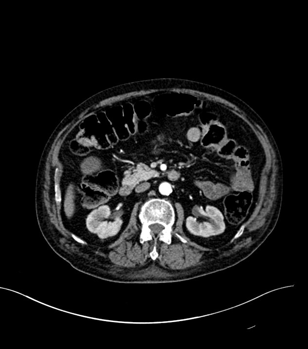 Cholangiocarcinoma with cerebral metastases (Radiopaedia 83519-98629 B 42).jpg
