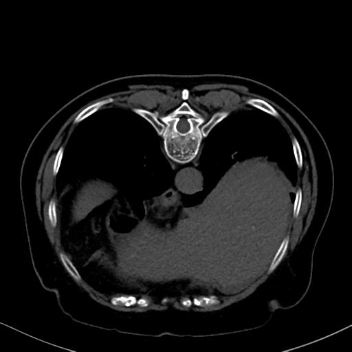 File:Cholecystitis - obstructive choledocholitiasis (CT intravenous cholangiography) (Radiopaedia 43966-47479 Axial 47).png