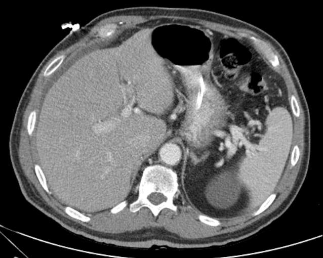 Cholecystitis - perforated gallbladder (Radiopaedia 57038-63916 A 20).jpg