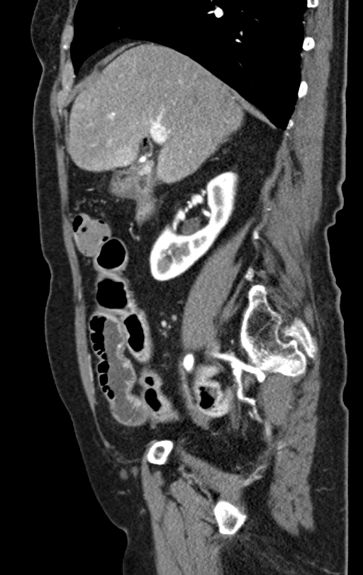 Cholecystoduodenal fistula due to calculous cholecystitis with gallstone migration (Radiopaedia 86875-103077 C 41).jpg