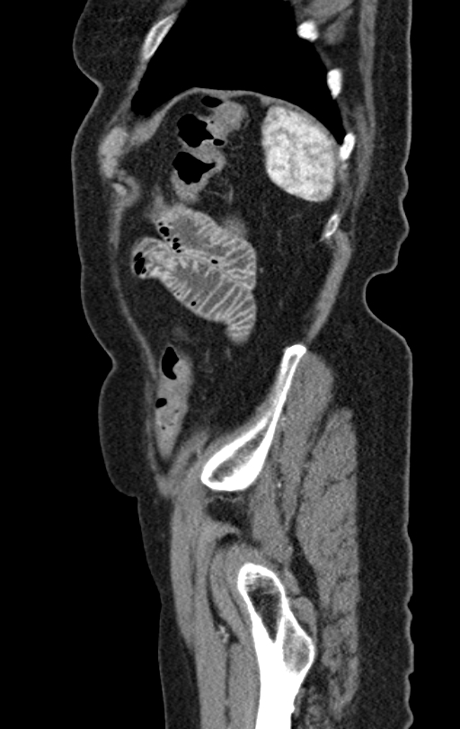 Cholecystoduodenal fistula due to calculous cholecystitis with gallstone migration (Radiopaedia 86875-103077 C 8).jpg