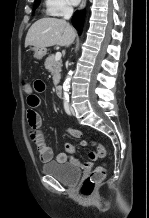 Cholecystoduodenal fistula due to calculous cholecystitis with gallstone migration (Radiopaedia 86875-103077 F 31).jpg