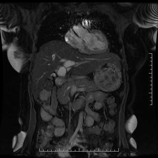 File:Choledochal cyst with chronic calcific pancreatitis (Radiopaedia 18245-18062 Coronal T2 1).png
