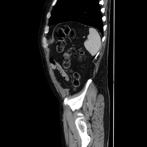 Choledocholiathiasis with normal caliber common bile duct (Radiopaedia 75368-86632 D 129).jpg