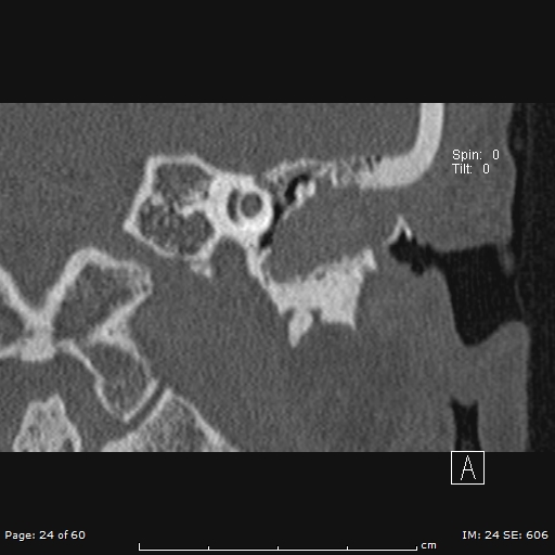 Cholesteatoma - external auditory canal (Radiopaedia 88452-105096 Coronal bone window 24).jpg
