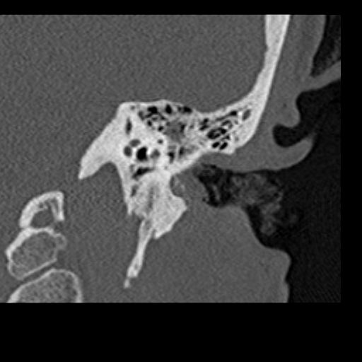 File:Cholesteatoma of the external ear (Radiopaedia 16540-16225 Coronal bone window 16).jpg