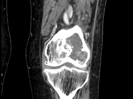 File:Chondrosarcoma - femur (Radiopaedia 64187-72954 C 33).jpg