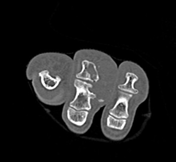 File:Chondrosarcoma - phalanx (Radiopaedia 69047-78812 Coronal bone window 1).jpg