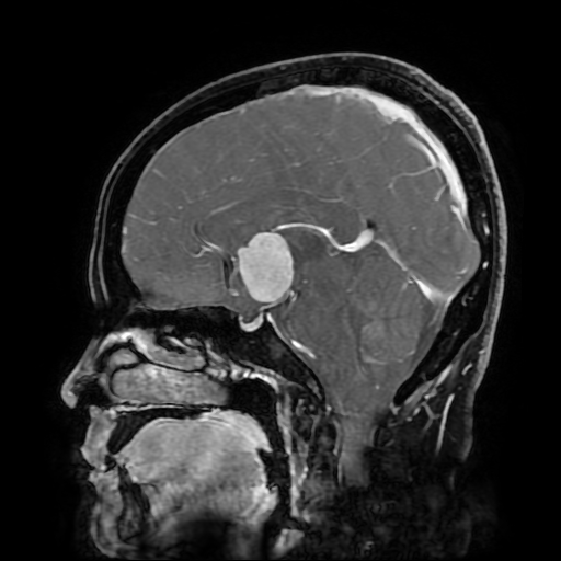 File:Chordoid glioma of third ventricle (Radiopaedia 91612-109340 F 110).jpg