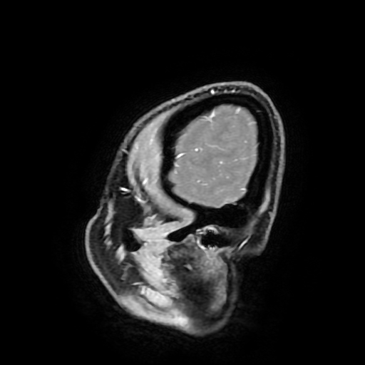 Chordoid glioma of third ventricle (Radiopaedia 91612-109340 F 29).jpg