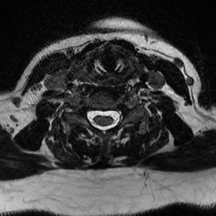 Chordoma - cervical spine (Radiopaedia 70084-80111 Axial T2 61).png
