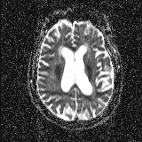 Choroid plexus xanthogranuloma - unilateral (Radiopaedia 85632-101393 Axial ADC 37).jpg