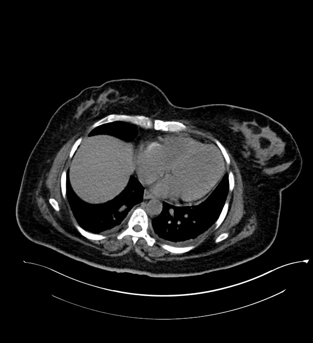 Chromophobe renal cell carcinoma (Radiopaedia 84239-99519 Axial non-contrast 19).jpg