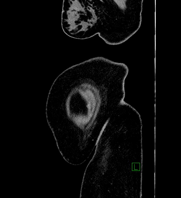 Chromophobe renal cell carcinoma (Radiopaedia 84239-99519 G 3).jpg