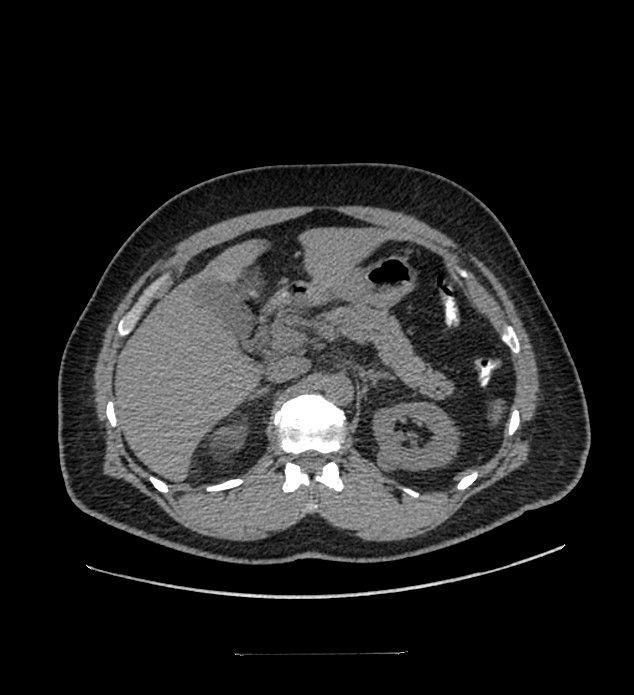 Chromophobe renal cell carcinoma (Radiopaedia 84337-99644 Axial non-contrast 30).jpg