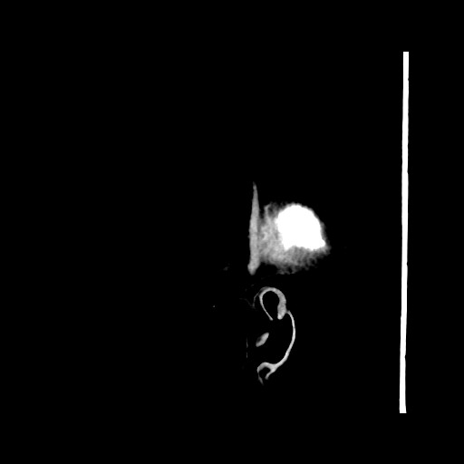 Chronic bilateral subdural hygroma (Radiopaedia 85801-101622 C 65).jpg