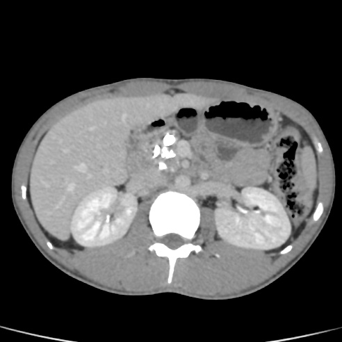 File:Chronic calcific pancreatitis (Radiopaedia 56280-62953 C 18).jpg