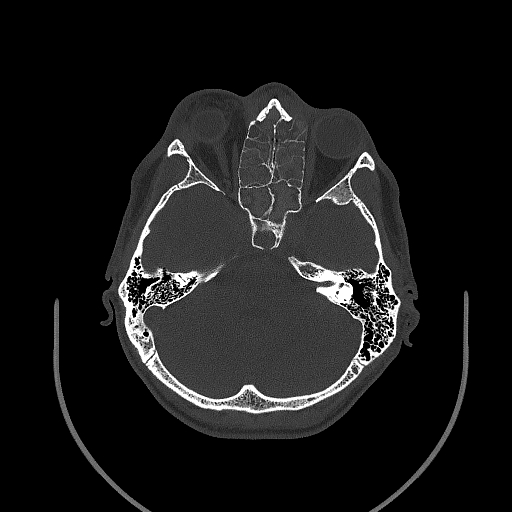 Chronic invasive fungal sinusitis (Radiopaedia 50342-55710 Axial bone window 80).jpg