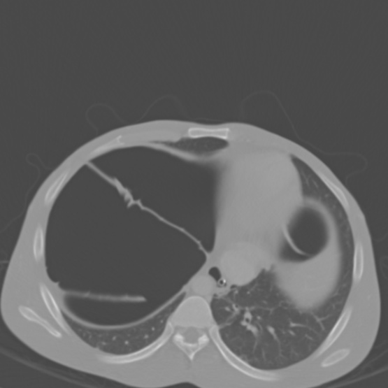 Chronic large bowel pseudo-obstruction (Radiopaedia 43181-46492 Axial bone window 30).jpg