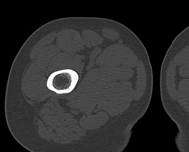 Chronic ostemyelitis of the femur with long sinus tract (Radiopaedia 74947-85982 Axial bone window 41).jpg