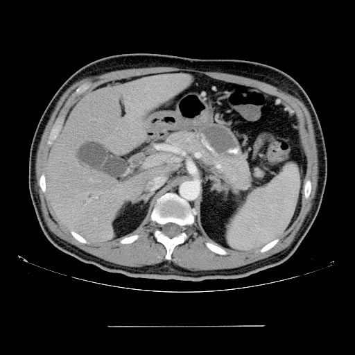 File:Chronic pancreatitis (Radiopaedia 11312-11676 D 1).jpg