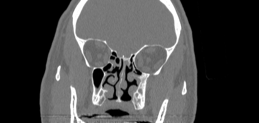 Chronic sphenoidal sinusitis (Radiopaedia 62030-70122 Coronal bone window 76).jpg