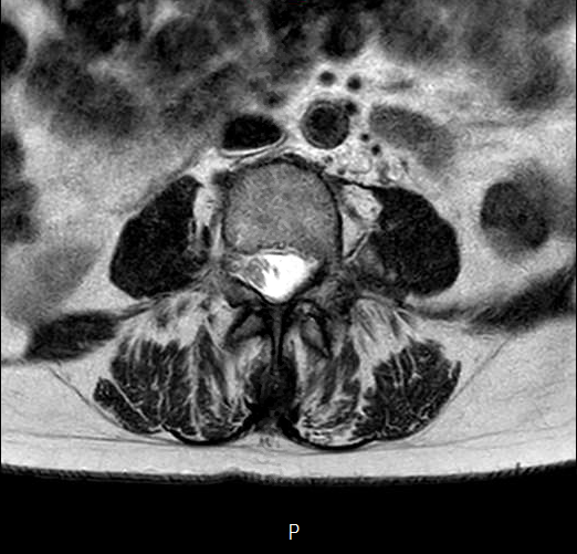 File:Chronic spinal hematoma with cauda equina syndrome (Radiopaedia 75745-87090 Axial T2 9).png