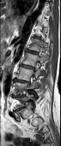 File:Chronic spinal hematoma with cauda equina syndrome (Radiopaedia 75745-87090 Sagittal T1 4).png