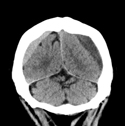 Chronic subdural hematomas (Radiopaedia 66577-75885 Coronal non-contrast 52).jpg