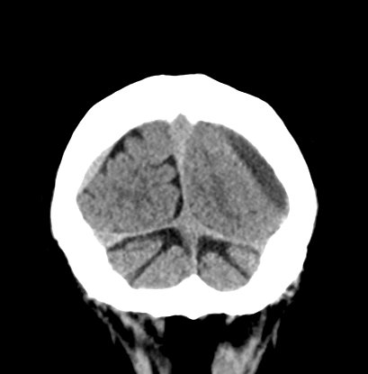 Chronic subdural hematomas (Radiopaedia 66577-75885 Coronal non-contrast 55).jpg