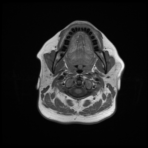 File:Chronic submandibular sialadenitis (Radiopaedia 61852-69885 Axial T1 10).jpg