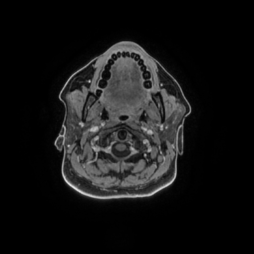 Chronic submandibular sialadenitis (Radiopaedia 61852-69885 Axial T1 C+ fat sat 85).jpg