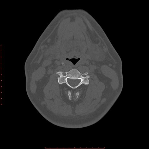 Chronic submandibular sialolithiasis (Radiopaedia 69817-79814 Axial bone window 89).jpg