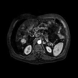 Cirrhosis and hepatocellular carcinoma in the setting of hemochromatosis (Radiopaedia 75394-86594 Axial T1 C+ fat sat 124).jpg