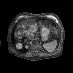 Cirrhosis and hepatocellular carcinoma in the setting of hemochromatosis (Radiopaedia 75394-86594 Axial T1 C+ fat sat 50).jpg